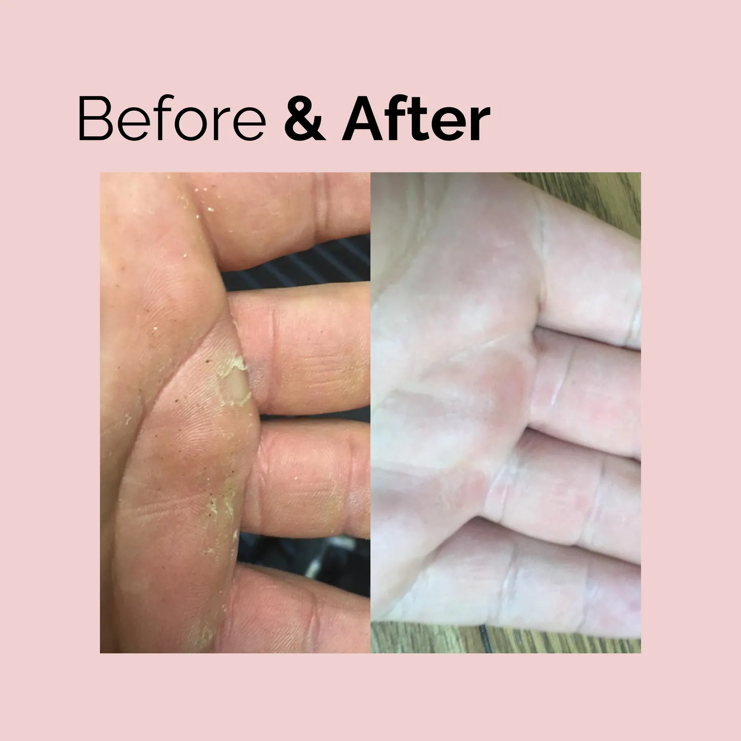 Dermatonics Hand Balm handbalsem droge handen vegan
